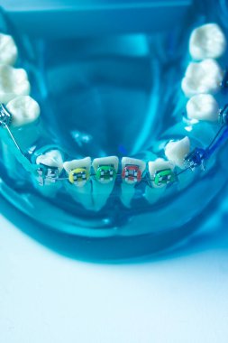 Modern metal parantez hizalayıcıları dişçiler tarafından dişlerin hizalanmasını düzeltmek için kullanılır.