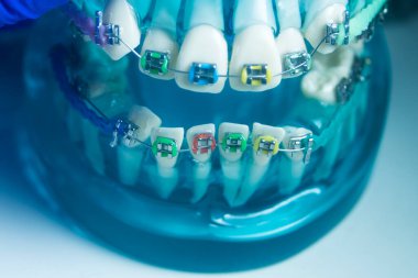 Modern metal parantez hizalayıcıları dişçiler tarafından dişlerin hizalanmasını düzeltmek için kullanılır.