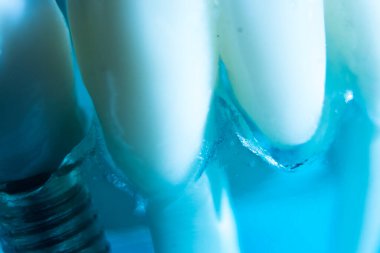 Diş macunu implantı. Diş ve sakız gösteren bir model..