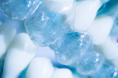 Modern görünmez parantez hizalayıcıları dişçiler tarafından dişlerin hizalanmasını düzeltmek için kullanılır.