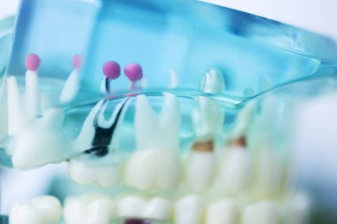 Diş çürüğü modeli dişlerdeki bakterileri gösteriyor.