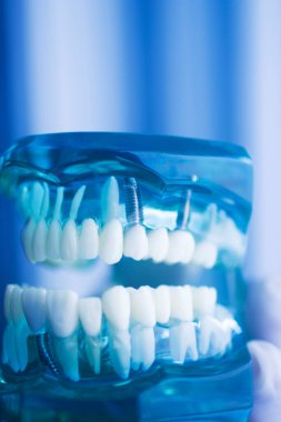 Diş implantı titanyum protez dişçi modeli..