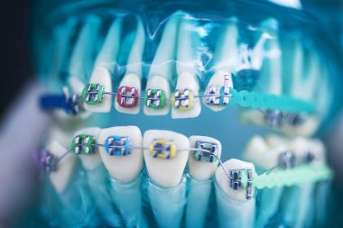 Diş macunu hizalayıcı diş etleri ve metal diş düzleştiricileri gösteren öğrenci modeli öğretiyor..