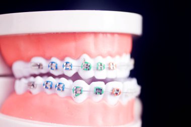 Diş macunu hizalayıcı diş etleri ve metal diş düzleştiricileri gösteren öğrenci modeli öğretiyor..