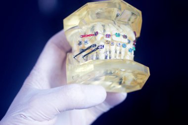 Diş macunu hizalayıcı diş etleri ve metal diş düzleştiricileri gösteren öğrenci modeli öğretiyor..