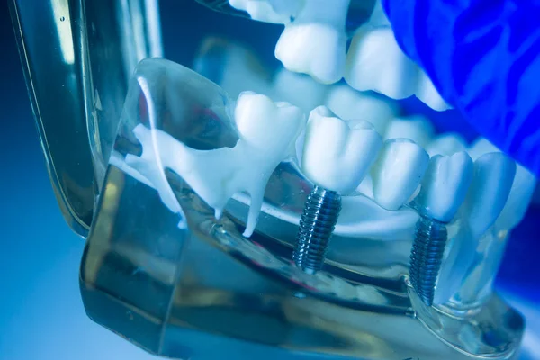 Denti Dentali Metallo Impianto Odontoiatria Insegnamento Modello Che Mostra Denti — Foto Stock