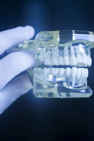 Modello Protesi Dentaria Protesica Titanio — Foto Stock