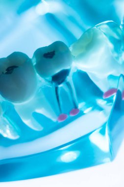 Diş çürükleri diş köklerine kadar iniyor. Tıbbi modellik öğretiyor..