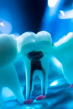 Diş çürükleri diş köklerine kadar iniyor. Tıbbi modellik öğretiyor..