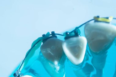 Modern metal parantez hizalayıcıları dişçiler tarafından dişlerin hizalanmasını düzeltmek için kullanılır.