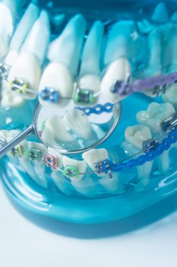 Modern metal parantez hizalayıcıları dişçiler tarafından dişlerin hizalanmasını düzeltmek için kullanılır.