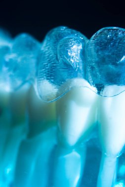 Modern görünmez parantez hizalayıcıları dişçiler tarafından dişlerin hizalanmasını düzeltmek için kullanılır.