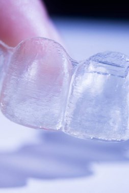 Modern görünmez parantez hizalayıcıları dişçiler tarafından dişlerin hizalanmasını düzeltmek için kullanılır.