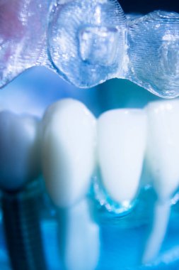 Modern görünmez parantez hizalayıcıları dişçiler tarafından dişlerin hizalanmasını düzeltmek için kullanılır.