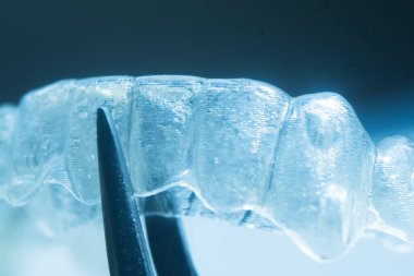 Modern görünmez parantez hizalayıcıları dişçiler tarafından dişlerin hizalanmasını düzeltmek için kullanılır.