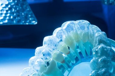 Modern görünmez parantez hizalayıcıları dişçiler tarafından dişlerin hizalanmasını düzeltmek için kullanılır.