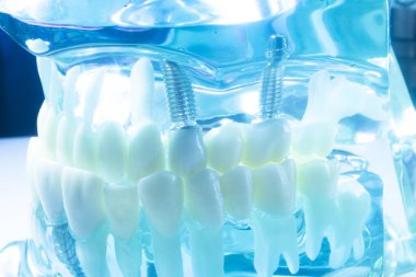 Modern görünmez parantez hizalayıcıları dişçiler tarafından dişlerin hizalanmasını düzeltmek için kullanılır.