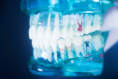 Diş çürüğü modeli dişlerdeki bakterileri gösteriyor.