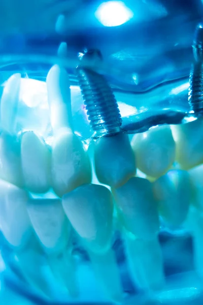 Modelo Enseñanza Odontología Implantes Metal Dental Que Muestra Dientes Encías —  Fotos de Stock