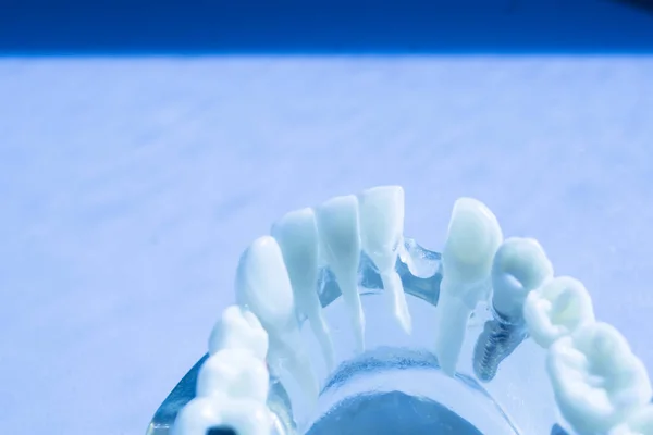 Modelo Enseñanza Odontología Implantes Metal Dental Que Muestra Dientes Encías —  Fotos de Stock