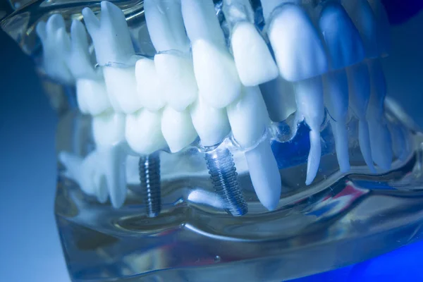 Denti Dentali Metallo Impianto Odontoiatria Insegnamento Modello Che Mostra Denti — Foto Stock
