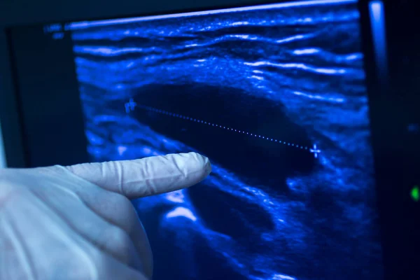 Epi Intratissue Perkutánní Elektrolýza Suché Jehly Ultrazvukové Ekografie Scan Fyzioterapie — Stock fotografie