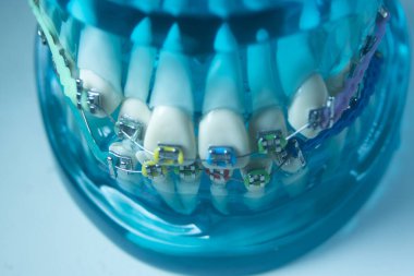 Modern metal parantez hizalayıcıları dişçiler tarafından dişlerin hizalanmasını düzeltmek için kullanılır.