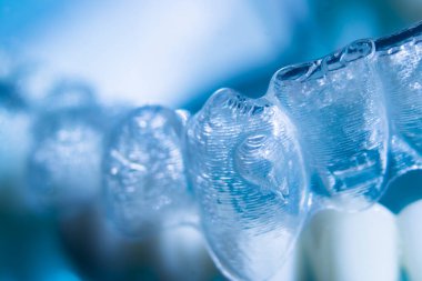 Modern görünmez parantez hizalayıcıları dişçiler tarafından dişlerin hizalanmasını düzeltmek için kullanılır.