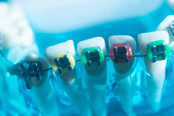 Modern Metal Brackets Aligner Straighterners Used Correct Alignment Teeth Dentists — Stock Photo, Image