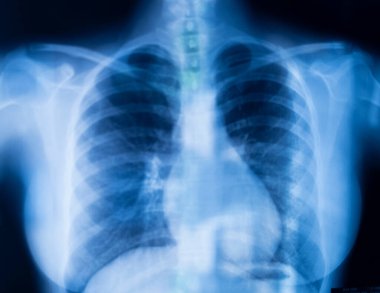 Akciğer kaburgaları x-ray tarama sonuçları.