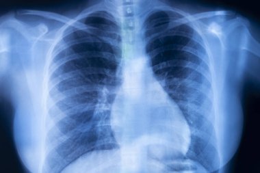 Akciğer kaburgaları x-ray tarama sonuçları.