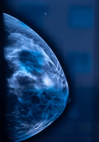 Mammographie Röntgenuntersuchung Der Brust Ergebnis Bild Für Gesunde Brüste Krebs — Stockfoto