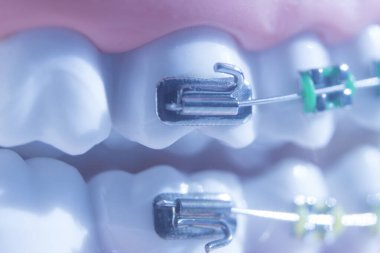 Modern metal parantez hizalayıcıları dişçiler tarafından dişlerin hizalanmasını düzeltmek için kullanılır.