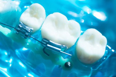 Modern metal parantez hizalayıcıları dişçiler tarafından dişlerin hizalanmasını düzeltmek için kullanılır.