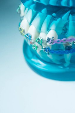 Modern metal parantez hizalayıcıları dişçiler tarafından dişlerin hizalanmasını düzeltmek için kullanılır.