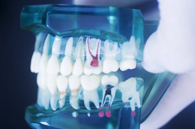 Diş çürüğü modeli dişlerdeki bakterileri gösteriyor.