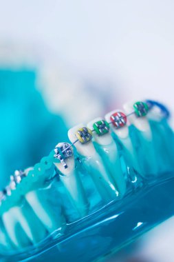 Diş macunu hizalayıcı diş etleri ve metal diş düzleştiricileri gösteren öğrenci modeli öğretiyor..