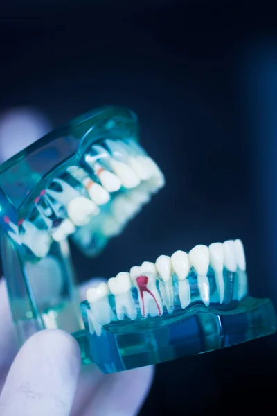 Modello Odontoiatria Carie Che Mostra Carie Nei Denti — Foto Stock