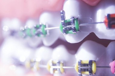 Modern metal parantez hizalayıcıları dişçiler tarafından dişlerin hizalanmasını düzeltmek için kullanılır.
