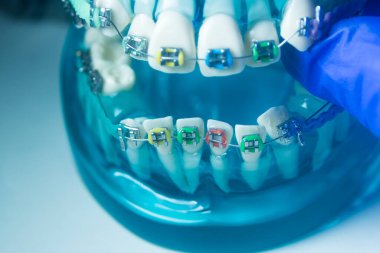 Modern metal parantez hizalayıcıları dişçiler tarafından dişlerin hizalanmasını düzeltmek için kullanılır.