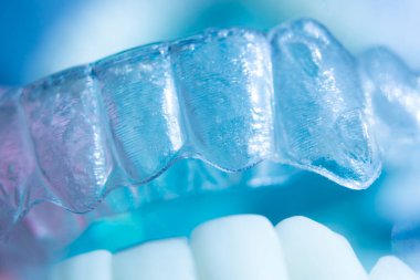 Modern görünmez parantez hizalayıcıları dişçiler tarafından dişlerin hizalanmasını düzeltmek için kullanılır.