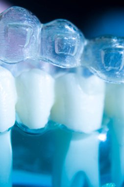 Modern görünmez parantez hizalayıcıları dişçiler tarafından dişlerin hizalanmasını düzeltmek için kullanılır.