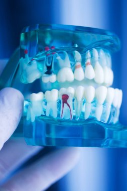 Diş çürüğü modeli dişlerdeki bakterileri gösteriyor.