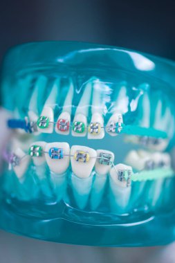 Diş macunu hizalayıcı diş etleri ve metal diş düzleştiricileri gösteren öğrenci modeli öğretiyor..