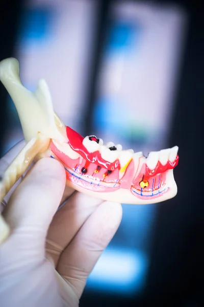 Zubní Kaz Zubní Lékaři Zubní Model Zubů Dásní Kořenového Kanálu — Stock fotografie