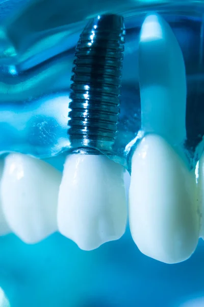 Modelo Enseñanza Odontología Implantes Metal Dental Que Muestra Dientes Encías — Foto de Stock