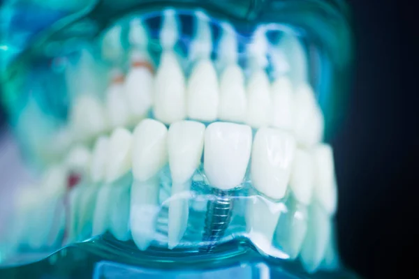 Implante Dental Modelo Dentistas Protésicos Titanio —  Fotos de Stock