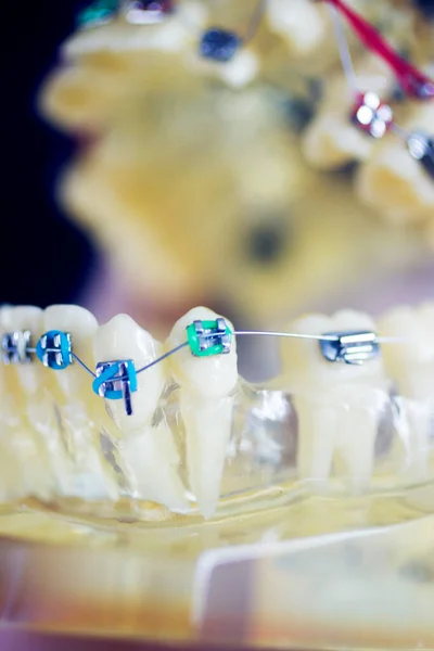 Dentaduras Dentárias Aligner Modelo Estudante Ensino Mostrando Gengivas Alisadores Dentes — Fotografia de Stock