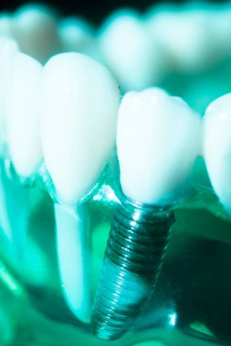 Diş macunu implantı. Diş ve sakız gösteren bir model..