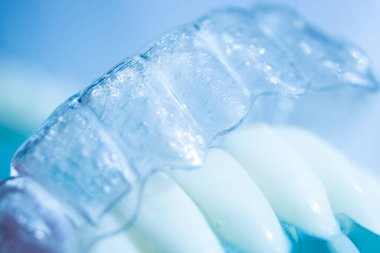 Modern görünmez parantez hizalayıcıları dişçiler tarafından dişlerin hizalanmasını düzeltmek için kullanılır.